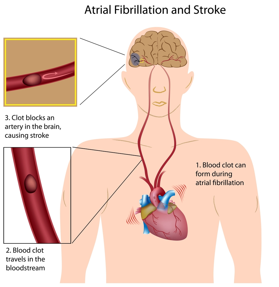 Afib and stroke.jpg